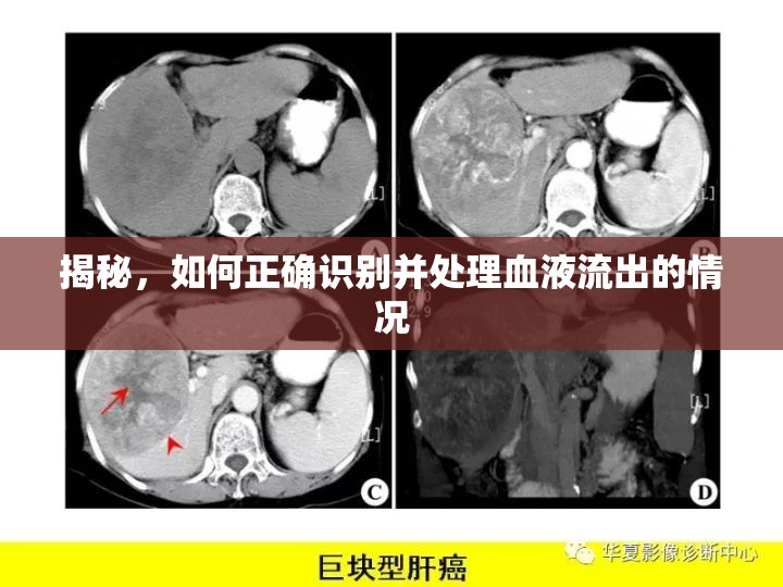 揭秘，如何正確識(shí)別并處理血液流出的情況