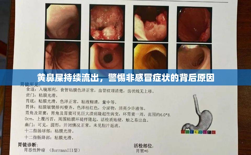 黃鼻屎持續(xù)流出，警惕非感冒癥狀的背后原因