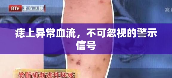 痣上異常血流，不可忽視的警示信號