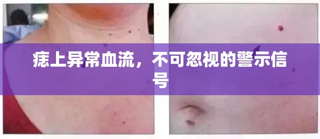 痣上異常血流，不可忽視的警示信號