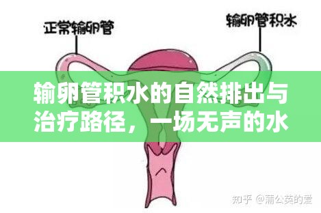 輸卵管積水的自然排出與治療路徑，一場(chǎng)無(wú)聲的水患之戰(zhàn)