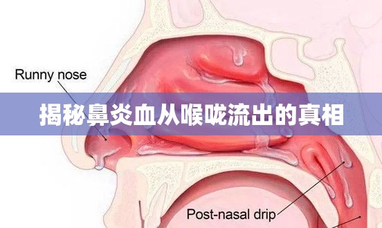 揭秘鼻炎血從喉嚨流出的真相