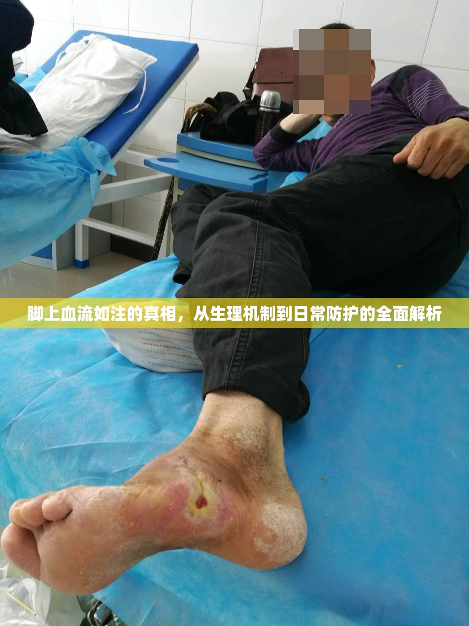 腳上血流如注的真相，從生理機制到日常防護的全面解析