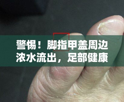 警惕！腳指甲蓋周邊濃水流出，足部健康警報不可忽視