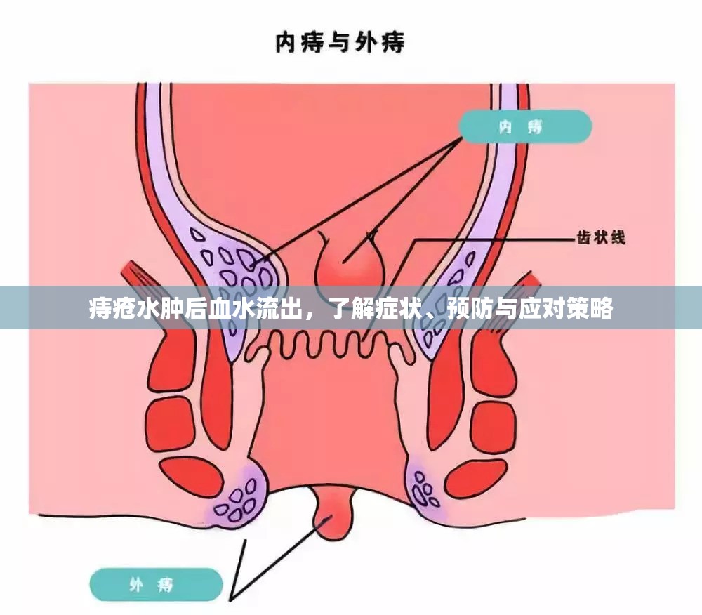 痔瘡水腫后血水流出，了解癥狀、預防與應對策略
