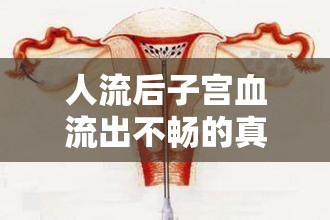 人流后子宮血流出不暢的真相與有效應(yīng)對策略