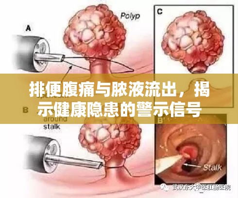 排便腹痛與膿液流出，揭示健康隱患的警示信號(hào)