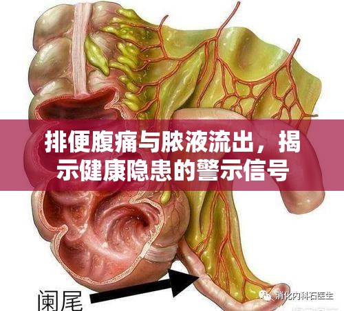 排便腹痛與膿液流出，揭示健康隱患的警示信號(hào)