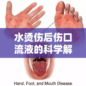 水燙傷后傷口流液的科學(xué)解析與家庭護(hù)理指南