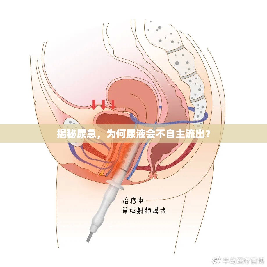 揭秘尿急，為何尿液會(huì)不自主流出？