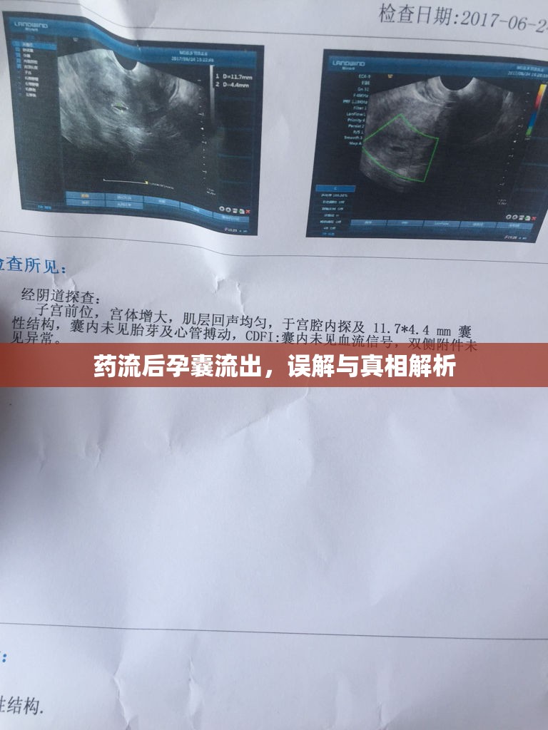 藥流后孕囊流出，誤解與真相解析