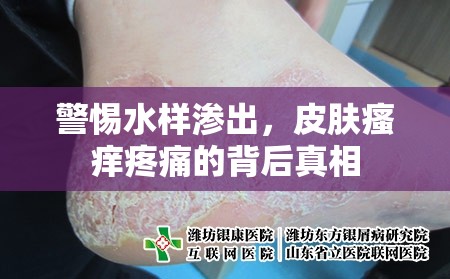 警惕水樣滲出，皮膚瘙癢疼痛的背后真相