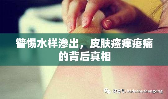 警惕水樣滲出，皮膚瘙癢疼痛的背后真相