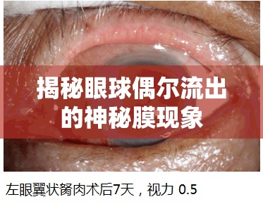 揭秘眼球偶爾流出的神秘膜現(xiàn)象