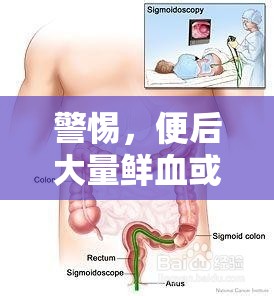 警惕，便后大量鮮血或為腸道健康紅色警報