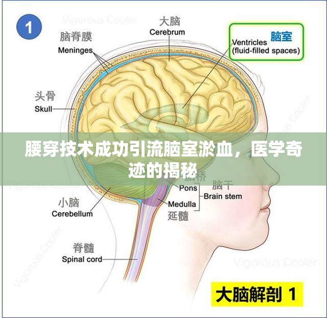 腰穿技術(shù)成功引流腦室淤血，醫(yī)學(xué)奇跡的揭秘