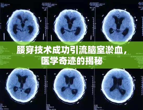 腰穿技術(shù)成功引流腦室淤血，醫(yī)學(xué)奇跡的揭秘
