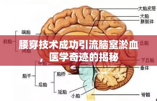 腰穿技術(shù)成功引流腦室淤血，醫(yī)學(xué)奇跡的揭秘