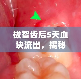 拔智齒后5天血塊流出，揭秘口腔恢復(fù)的小插曲