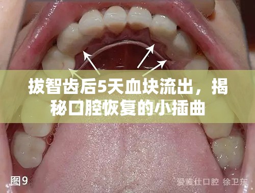 拔智齒后5天血塊流出，揭秘口腔恢復(fù)的小插曲
