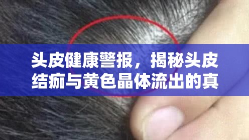 頭皮健康警報(bào)，揭秘頭皮結(jié)痂與黃色晶體流出的真相