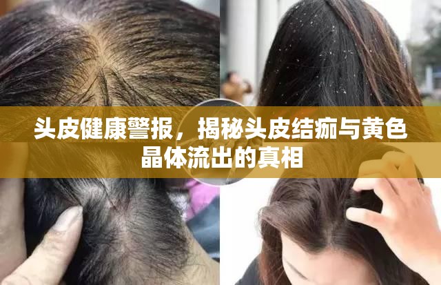 頭皮健康警報(bào)，揭秘頭皮結(jié)痂與黃色晶體流出的真相
