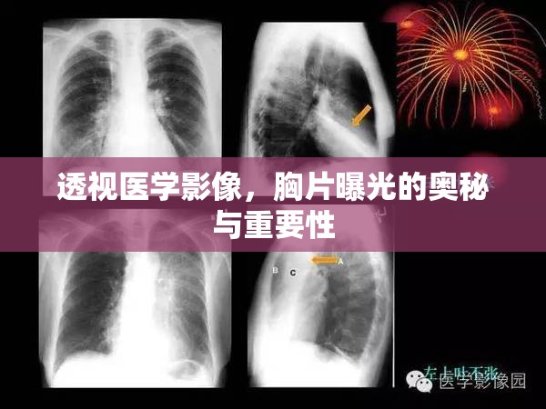 透視醫(yī)學(xué)影像，胸片曝光的奧秘與重要性