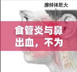 食管炎與鼻出血，不為人知的隱秘聯(lián)系