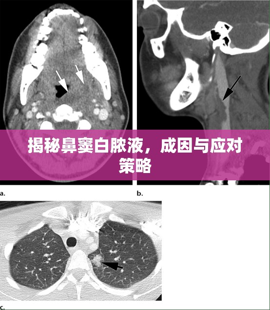揭秘鼻竇白膿液，成因與應(yīng)對策略