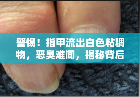 警惕！指甲流出白色粘稠物，惡臭難聞，揭秘背后的健康隱患