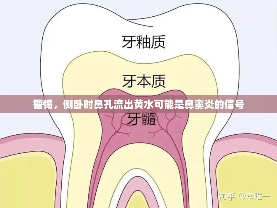 警惕，側(cè)臥時(shí)鼻孔流出黃水可能是鼻竇炎的信號(hào)