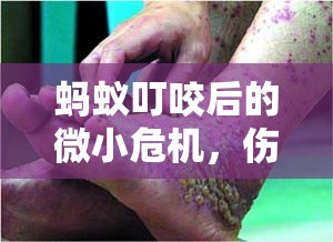 螞蟻叮咬后的微小危機(jī)，傷口流水的處理與預(yù)防