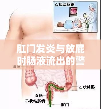 肛門發(fā)炎與放屁時(shí)腸液流出的警示，了解癥狀，重視健康