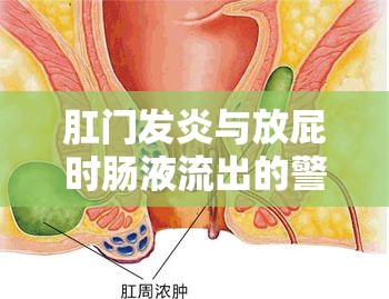 肛門發(fā)炎與放屁時(shí)腸液流出的警示，了解癥狀，重視健康