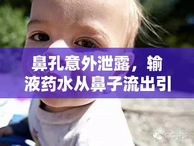 鼻孔意外泄露，輸液藥水從鼻子流出引發(fā)的醫(yī)療事故