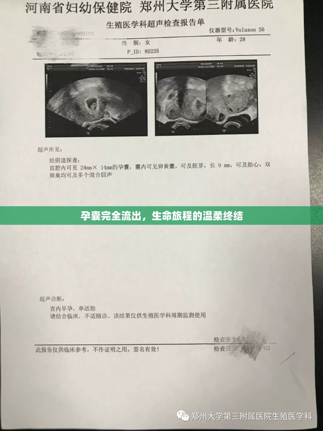 孕囊完全流出，生命旅程的溫柔終結(jié)