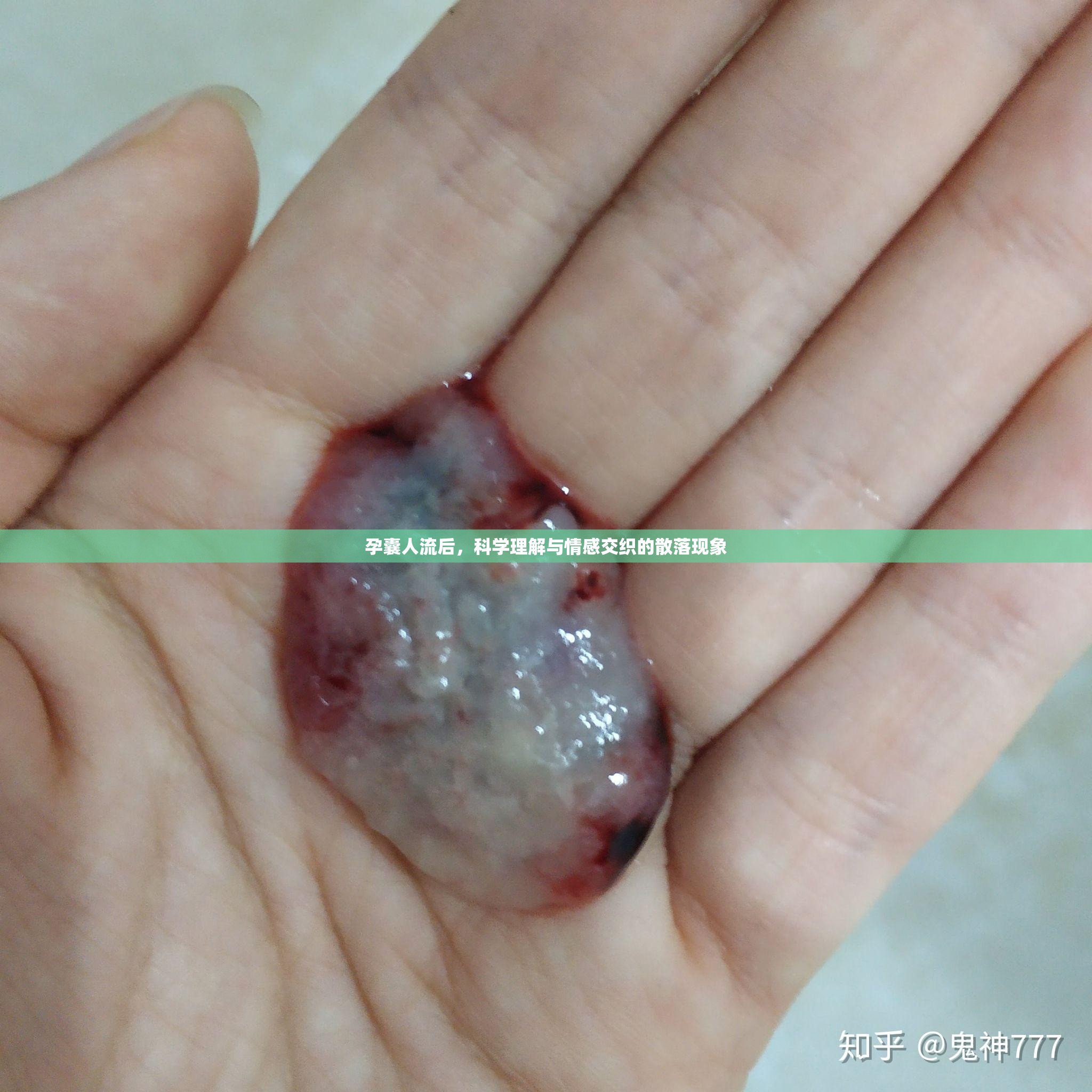 孕囊人流后，科學(xué)理解與情感交織的散落現(xiàn)象