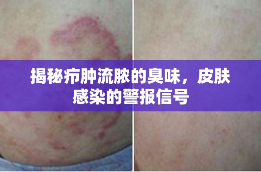 揭秘癤腫流膿的臭味，皮膚感染的警報信號