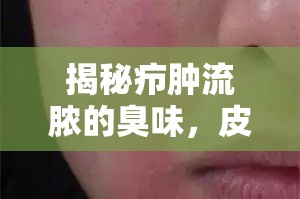 揭秘癤腫流膿的臭味，皮膚感染的警報信號