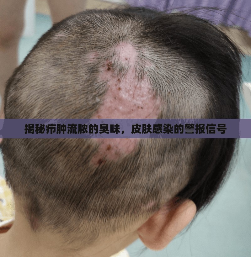 揭秘癤腫流膿的臭味，皮膚感染的警報信號
