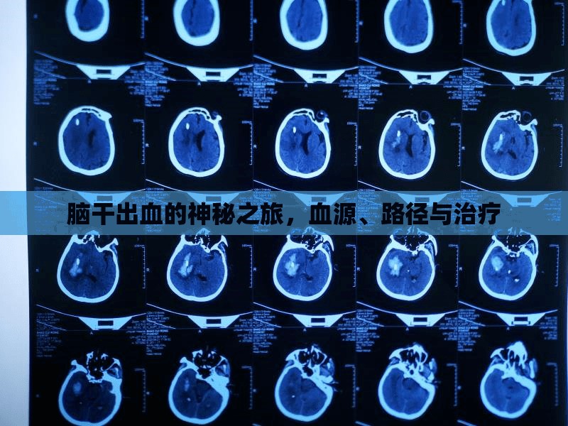 腦干出血的神秘之旅，血源、路徑與治療
