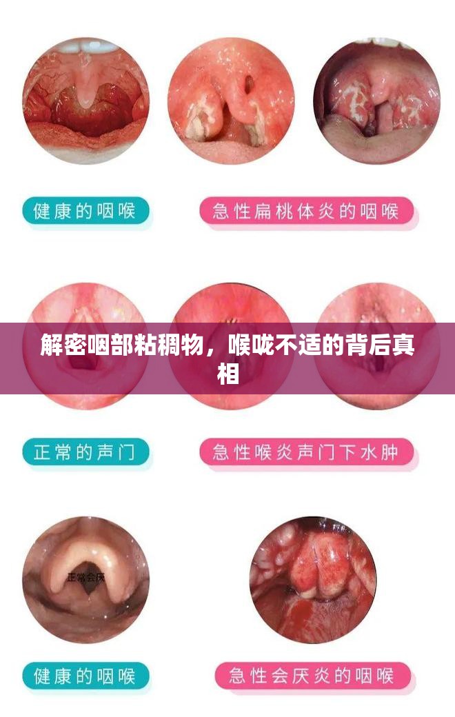 解密咽部粘稠物，喉嚨不適的背后真相