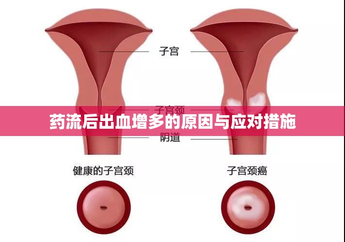 藥流后出血增多的原因與應(yīng)對(duì)措施