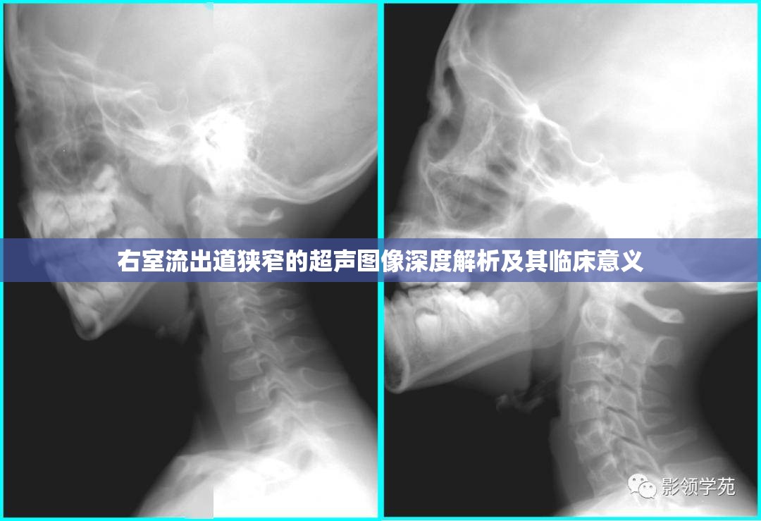 右室流出道狹窄的超聲圖像深度解析及其臨床意義