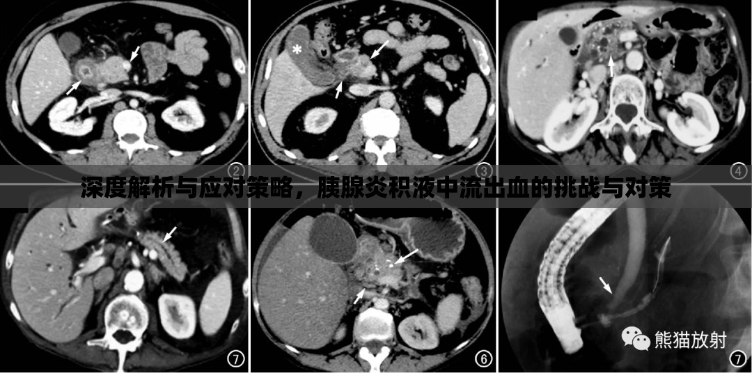 深度解析與應(yīng)對(duì)策略，胰腺炎積液中流出血的挑戰(zhàn)與對(duì)策
