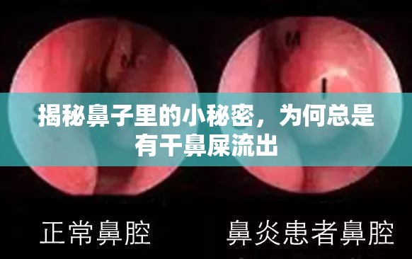揭秘鼻子里的小秘密，為何總是有干鼻屎流出