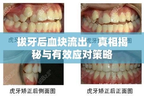 拔牙后血塊流出，真相揭秘與有效應(yīng)對策略