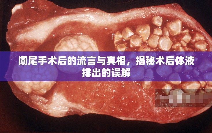 闌尾手術(shù)后的流言與真相，揭秘術(shù)后體液排出的誤解