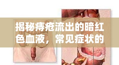 揭秘痔瘡流出的暗紅色血液，常見癥狀的神秘面紗
