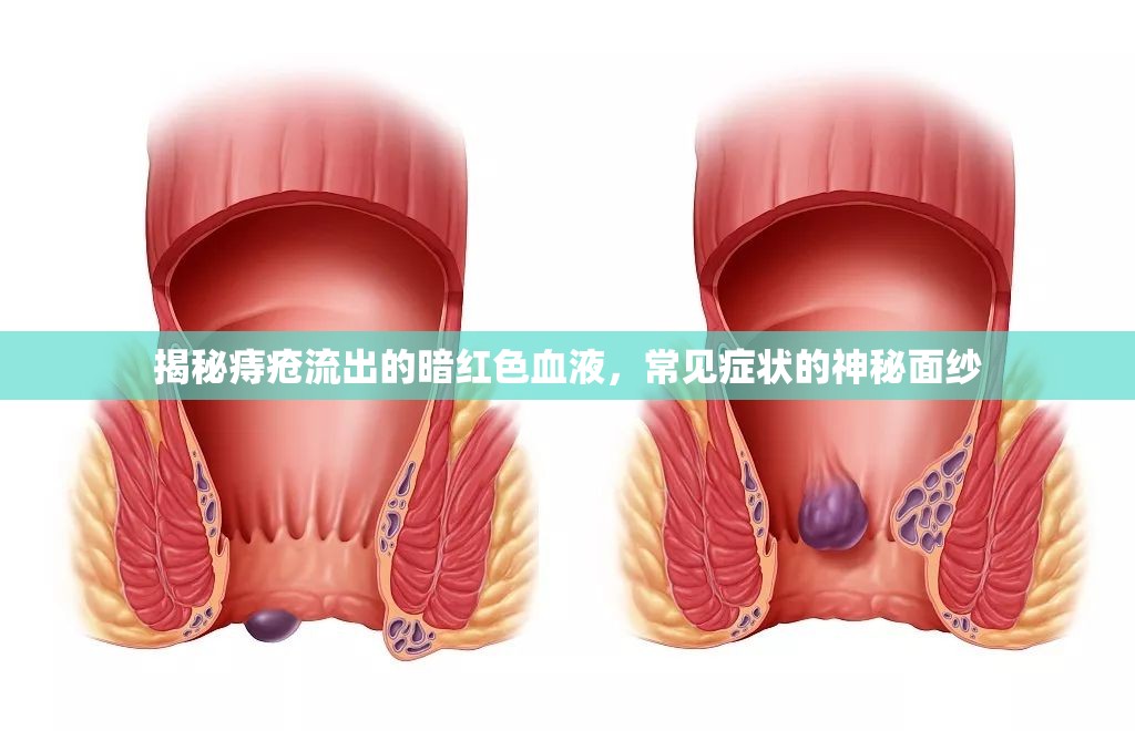 揭秘痔瘡流出的暗紅色血液，常見癥狀的神秘面紗